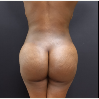 25-34 year old woman treated with Liposuction after 3363914