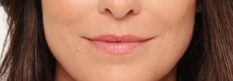 Woman with just 2 syringes of Radiesse® after 1970192