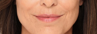 Woman with just 2 syringes of Radiesse® before 1970192