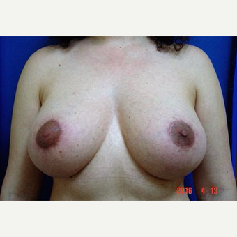 Breast Lift, Aug, Remove and Replace Implants before 3232876
