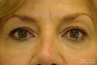 55 year-old woman underwent Restylane injections to blend away eyebags and give a virtual cheeklift. after 1493290
