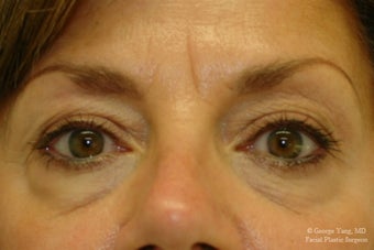 55 year-old woman underwent Restylane injections to blend away eyebags and give a virtual cheeklift. before 1493290