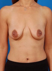 Benelli Breast Lift before 429342