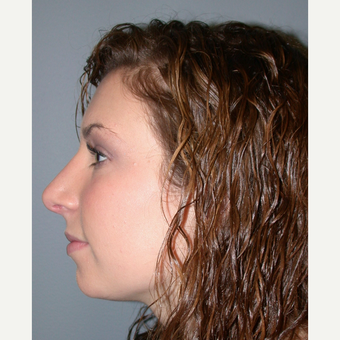 18-24 year old woman treated with Rhinoplasty after 3692247