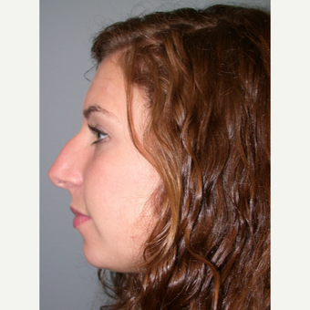 18-24 year old woman treated with Rhinoplasty before 3692247