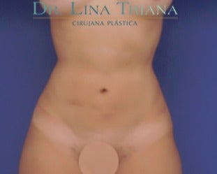 25-34 year old woman treated with Liposculpture after 3543902