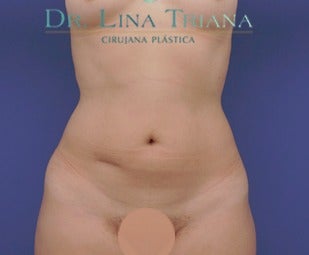 25-34 year old woman treated with Liposculpture before 3543902