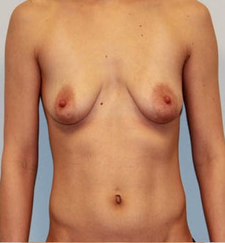 Dual Plane III (submuscular) Augmentation with Circumvertical Mastopexy before 932594
