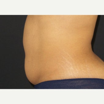 35-44 year old woman treated with CoolSculpting before 2407301