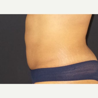 35-44 year old woman treated with CoolSculpting after 2407301