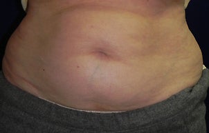 Vanquish Non Invasive Fat Reduction to Abdomen after 1256319