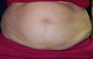 Vanquish Non Invasive Fat Reduction to Abdomen before 1256319