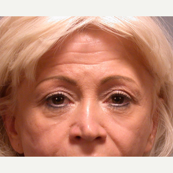 Eyelid Surgery before 3123683