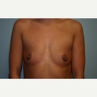 35-44 year old woman treated with Breast Augmentation before 3564273