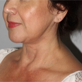 55 year old female treated with MACS face lift and full neck lift after massive weight loss. after 3711005