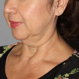 55 year old female treated with MACS face lift and full neck lift after massive weight loss. before 3711005