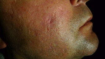 Juvederm filer to acne scar before 1469927