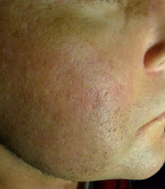 Juvederm filer to acne scar after 1469927