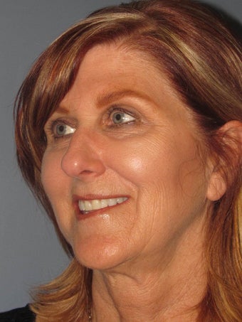 Blue Peel®, LiteLift™, Platysmaplasty on 57-year-old Woman 1149663