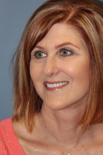 Blue Peel®, LiteLift™, Platysmaplasty on 57-year-old Woman 1149663