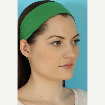 25-34 year old woman treated with Rhinoplasty before 3691080