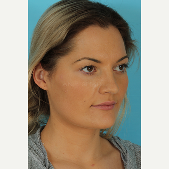 25-34 year old woman treated with Rhinoplasty after 3691080
