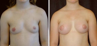 21 year old female, breast augmentation before 628310