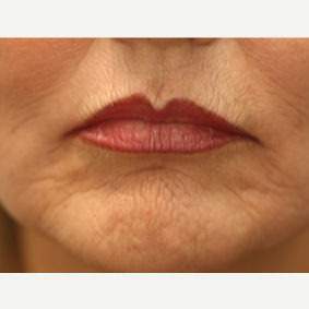 55-64 year old woman treated with Chemical Peel before 3646129