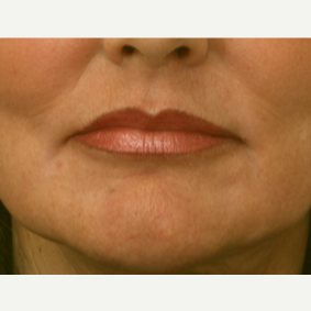 55-64 year old woman treated with Chemical Peel after 3646129