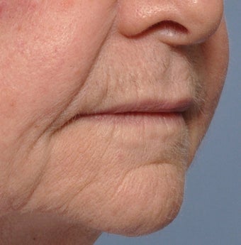 75 Year Old Female Treated For Thin Aging Lips 925514