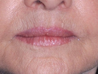 75 Year Old Female Treated For Thin Aging Lips after 925514