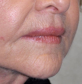 75 Year Old Female Treated For Thin Aging Lips 925514