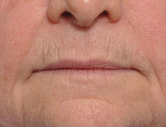 75 Year Old Female Treated For Thin Aging Lips before 925514