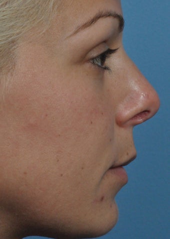 25-34 year old woman treated with Revision Rhinoplasty after 2106871