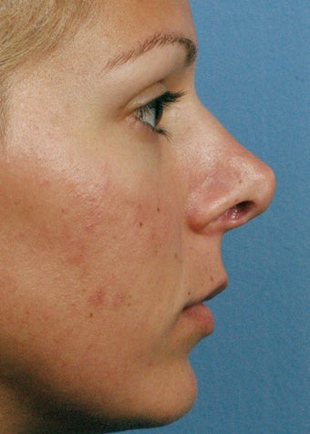 25-34 year old woman treated with Revision Rhinoplasty before 2106871