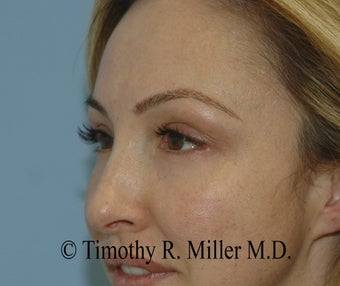Lower eyelid rejuvenation 1447436