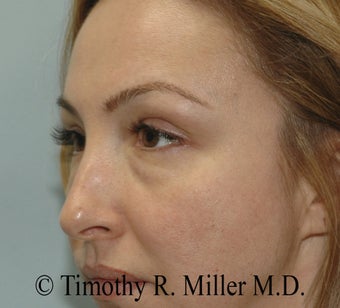 Lower eyelid rejuvenation 1447436
