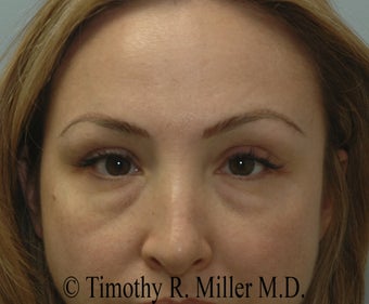 Lower eyelid rejuvenation before 1447436