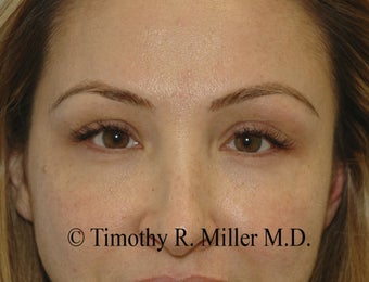 Lower eyelid rejuvenation after 1447436