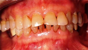 55-64 year old woman treated with Dental Implants before 3323007