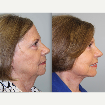 69 year old woman treated with Neck Lift after 3305890