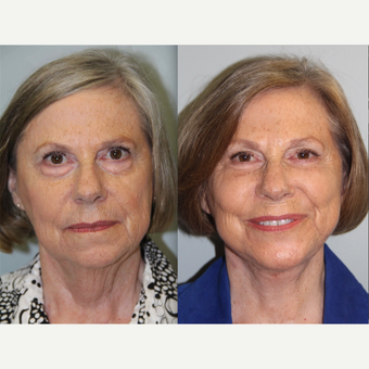 69 year old woman treated with Neck Lift before 3305890