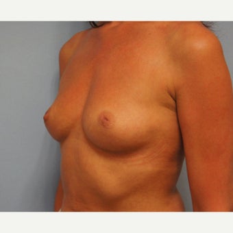 Patient who underwent Inverted Nipple surgery combined with Breast Enlargement. 1602848