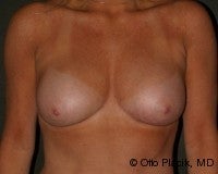Breast Augmentation with Fat Grafting after 574435
