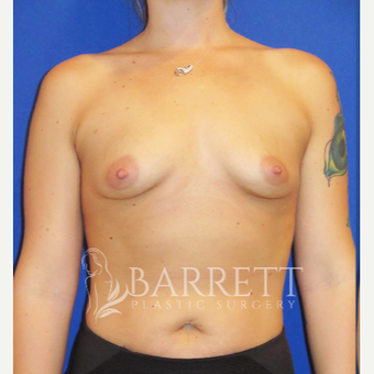 35-44 year old woman treated with Breast Implants before 3584433