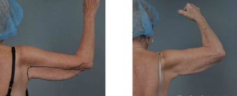 ThermiTight patient before 1110543