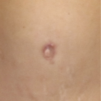 Belly Button Surgery for this 40 Year Old Woman after 3059316
