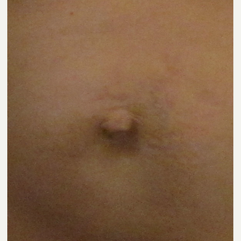 Belly Button Surgery for this 40 Year Old Woman before 3059316