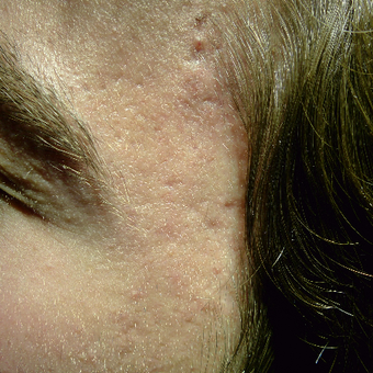 Fillers and subcision before 3366074