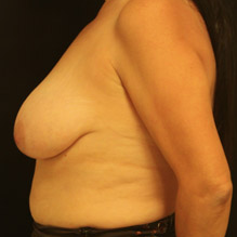 45-54 year old woman treated with Breast Lift before 3742373